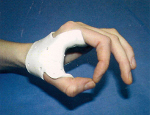 C-Splint