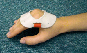 Ulnarissplint